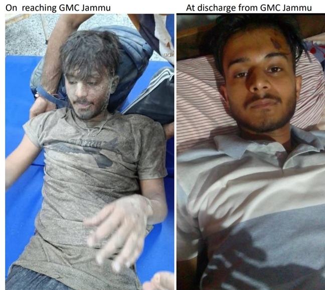 Under Ashutosh, GMC Jammu provides World Class treatment to victims of  Kishtwar Tragedy